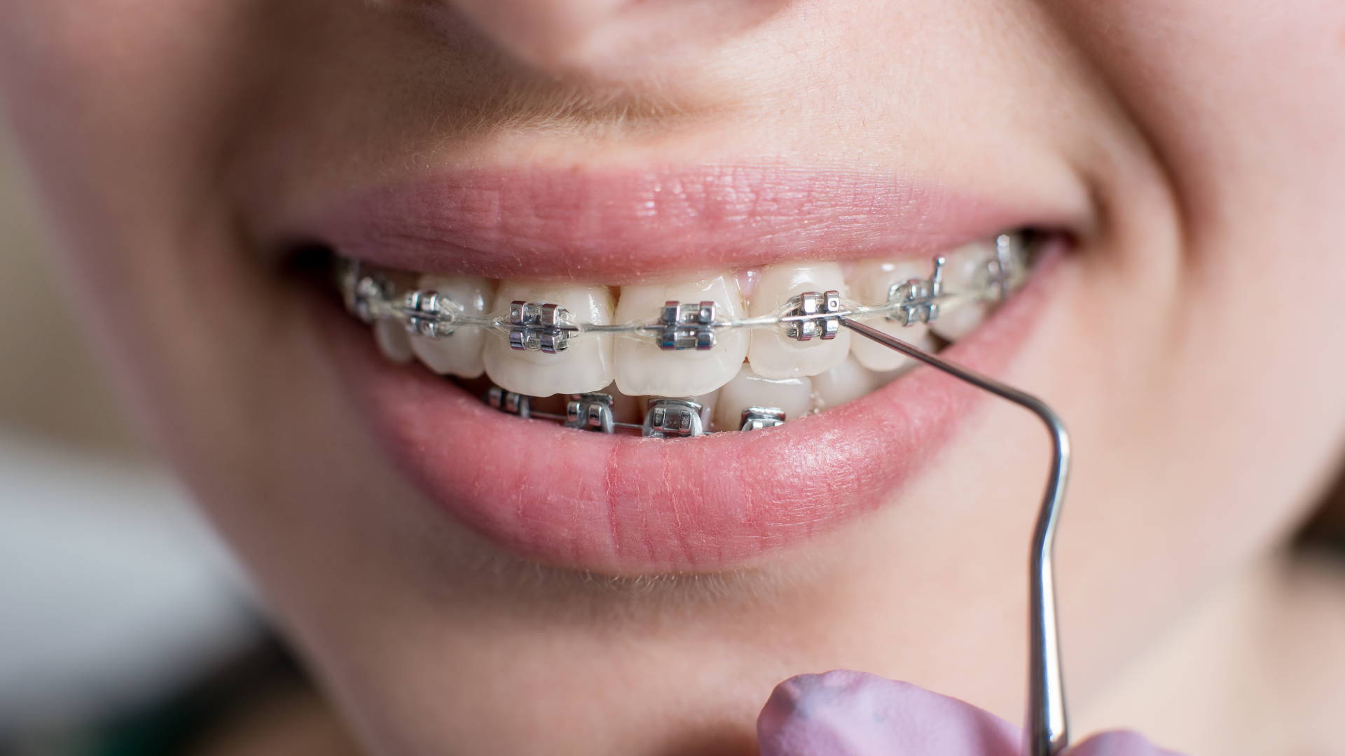 Orthodontie Classique Lille